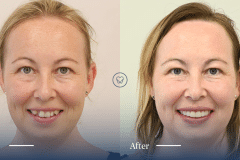 Amy-of-Mascot_Invisalign-and-Composite-Bonding-Makeover