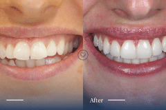 Chanel-of-Mascot_Invisalign-and-Composite-Bonding-Makeover