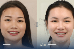 Kim-of-Mascot_Invisalign-and-Composite-Bonding-Makeover