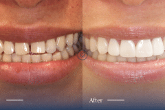Mandy-of-Mascot_Invisalign-and-Composite-Bonding-Makeover