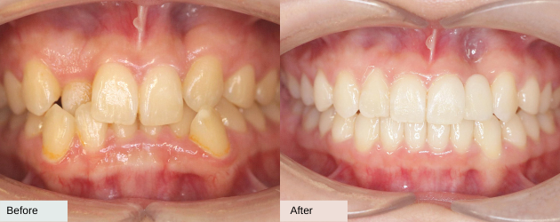 An Anterior Crossbite - Before And After Image In Mascot, Sydney In Delight Dental Spa