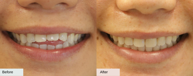 An Open Bite - Before And After Image In Mascot, Sydney In Delight Dental Spa