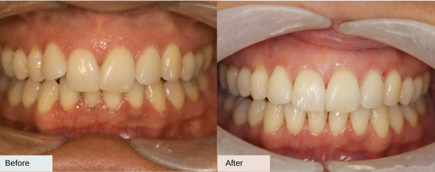 An Overbite - Before And After Image In Mascot, Sydney In Delight Dental Spa
