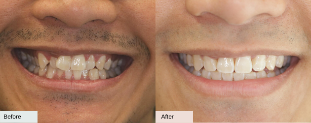 An Overly Crowded Teeth - Before And After Image In Mascot, Sydney In Delight Dental Spa