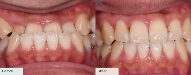 An Underbite - Before And After Image In Mascot, Sydney In Delight Dental Spa