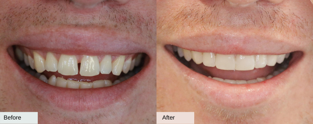 Gapped Teeth - Before And After Image In Mascot, Sydney In Delight Dental Spa