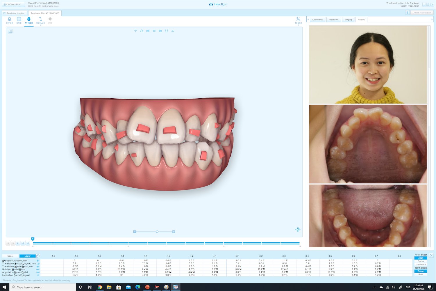 What Are The Steps For Invisalign Treatment In Mascot, Sydney In Delight Dental Spa