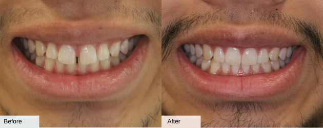 Looking at Invisalign Before And After photos In Mascot, Sydney In Delight Dental Spa