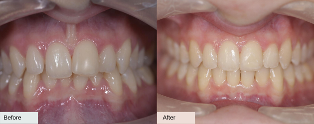 Invisalign Overbite Before And After In Mascot, Sydney In Delight Dental Spa