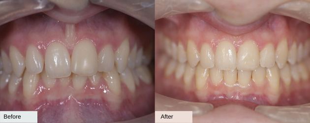 A Comprehensive Guide to Invisalign Attachments