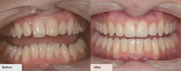 Teeth Straightening Solution For Minor To Complex Cases In Mascot, Sydney In Delight Dental Spa
