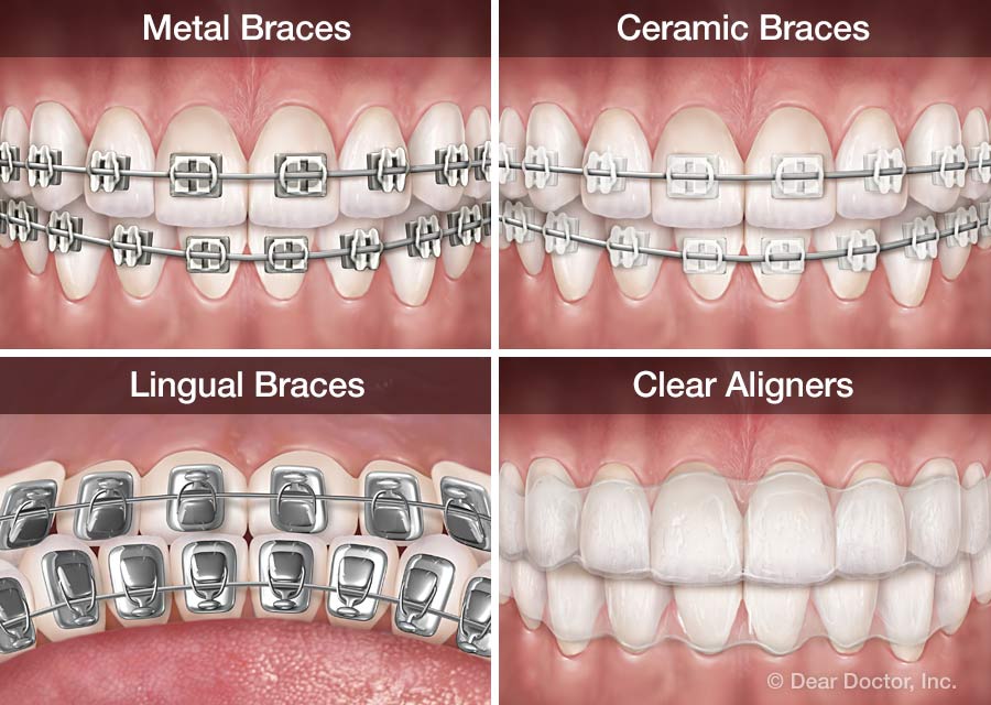 Differences Between Invisalign Braces vs. Ceramic Braces