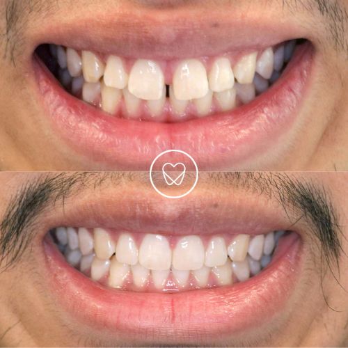 Patient 1 Of Pagewood's Invisalign Makeover