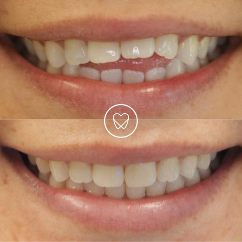 Patient 2 Of St Peters Invisalign Makeover