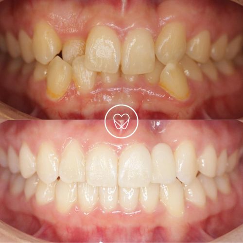 Phuong Of Eastlakes Invisalign Makeover