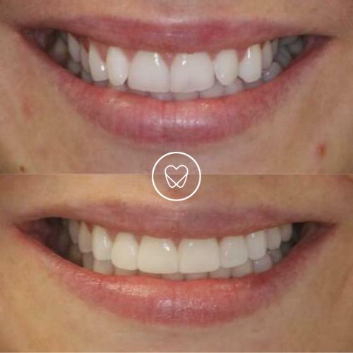 Rosie Of Pagewood's Invisalign Makeover