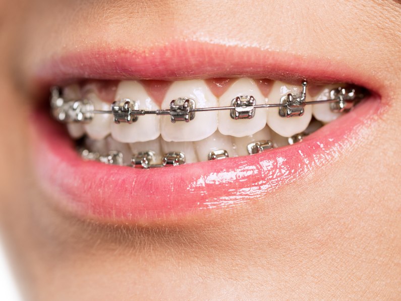 Traditional Braces At Mascot, Sydney In Delight Dental Spa