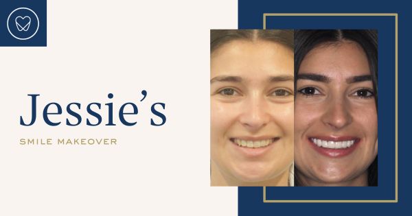 Jessie of Drummoyne’s Invisalign, Teeth-Whitening and Porcelain Veneers Makeover