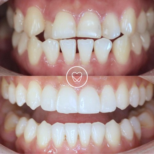 Dane Of Marrickville’s Invisalign, Teeth Whitening, Composite Bonding Makeover