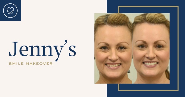 Jenny of Cronulla’s Gum Recontouring, Composite Veneers and Night Guard Makeover