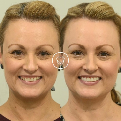 Jenny Of Cronulla’s Gum Recontouring, Composite Veneers And Night Guard Makeover