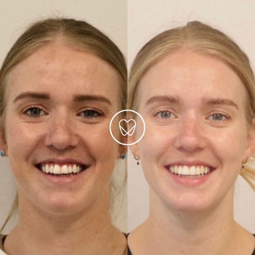 Nina Of Waterloo’s Invisalign, Teeth Whitening, Composite Bonding Makeover