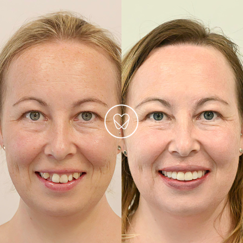 Amy Of Mascot’s Invisalign And Composite Bonding Makeover