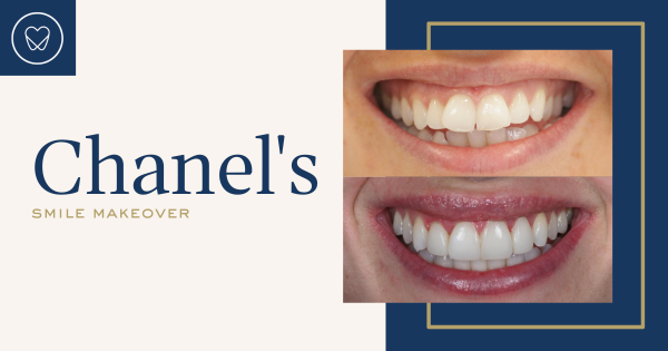 Chanel Of Mascot’s Invisalign And Composite Bonding Makeover In Delight Dental Spa