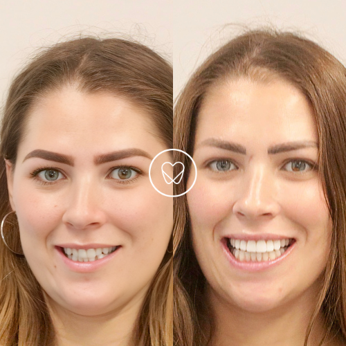 Kate Of Mascot’s Invisalign And Composite Bonding Makeover