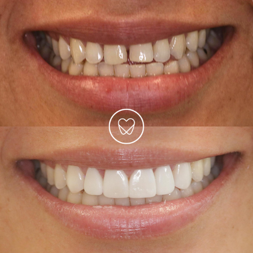 Mandy Of Mascot’s Invisalign And Composite Bonding Makeover