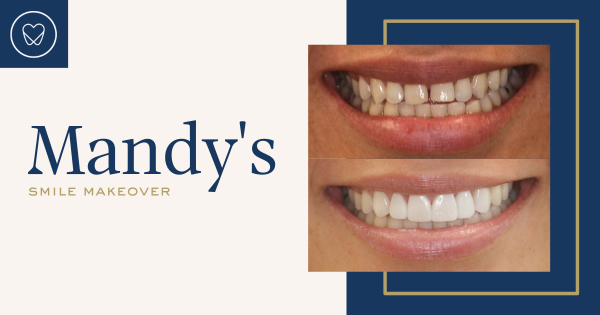 Mandy of Mascot’s Invisalign and Composite Bonding Makeover