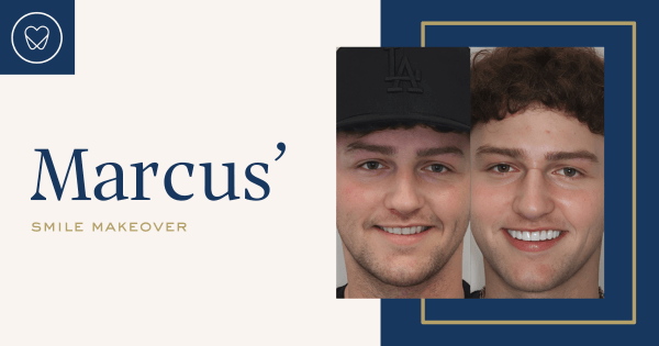 Marcus of Mascot’s Composite Veneers and Teeth Whitening Makeover